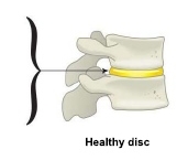 San Diego Herniated Disc Treatment