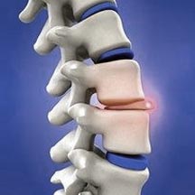 San Diego Chiropractor Bulging Disc Treatment