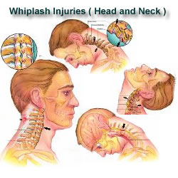 San Diego Whiplash and Auto Accident Treatment